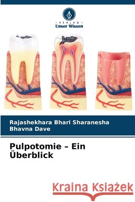Pulpotomie - Ein Überblick Bhari Sharanesha, Rajashekhara, Dave, Bhavna 9786209893735 Verlag Unser Wissen