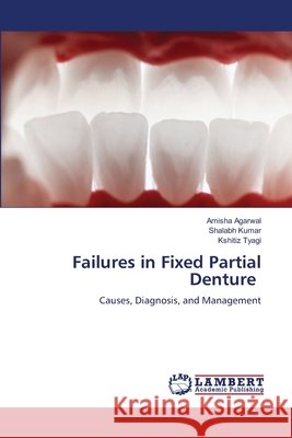 Failures in Fixed Partial Denture Amisha Agarwal Shalabh Kumar Kshitiz Tyagi 9786209967238