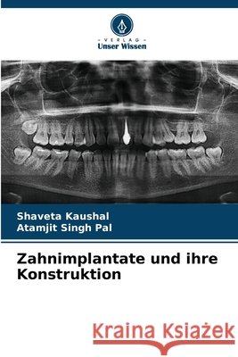 Zahnimplantate und ihre Konstruktion Shaveta Kaushal Atamjit Singh Pal 9786630180763