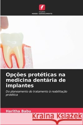 Op??es prot?ticas na medicina dent?ria de implantes Haritha Babu 9786630223842