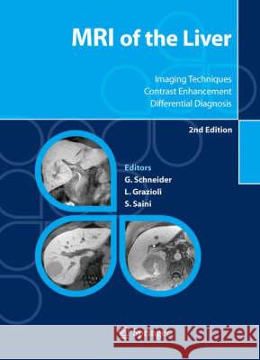 MRI of the Liver: Imaging Techniques, Contrast Enhancement, Differential Diagnosis Schneider, Günther 9788847003354 Springer