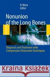Nonunion of the Long Bones: Diagnosis and Treatment with Compression-Distraction Techniques Paley, D. 9788847004085 Springer