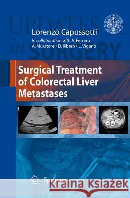 Surgical Treatment of Colorectal Liver Metastases Lorenzo Capussotti 9788847018082 Not Avail