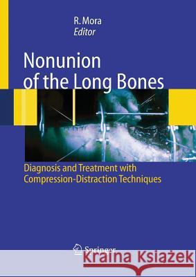 Nonunion of the Long Bones: Diagnosis and Treatment with Compression-Distraction Techniques Paley, D. 9788847055636 Springer