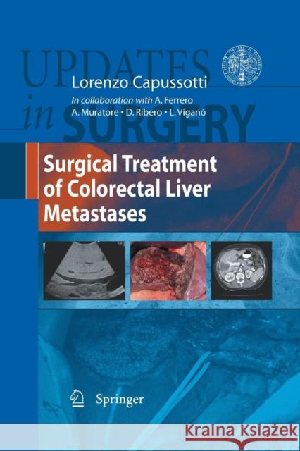 Surgical Treatment of Colorectal Liver Metastases Lorenzo Capussotti 9788847055940 Springer