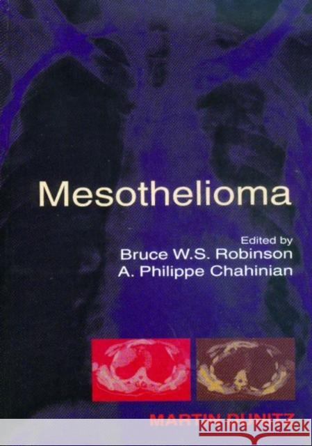 Mesothelioma Bruce W. S. Robinson A. Philippe Chahinian Robinson W. S. Robinson 9789058231802 Taylor & Francis Group