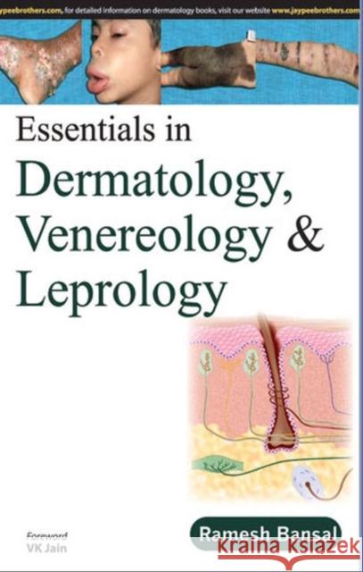 Essentials in Dermatology, Venereology & Leprology Ramesh Bansal 9789350257203