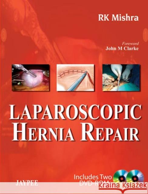 Laparoscopic Hernia Repair RK Mishra 9789350258729 0