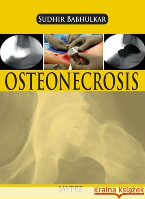Osteonecrosis Sudhir Babhulkar 9789350904077 Jp Medical Ltd