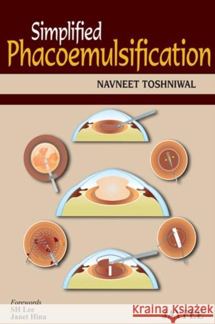 Simplified Phacoemulsification Navneet Toshniwal 9789350904428