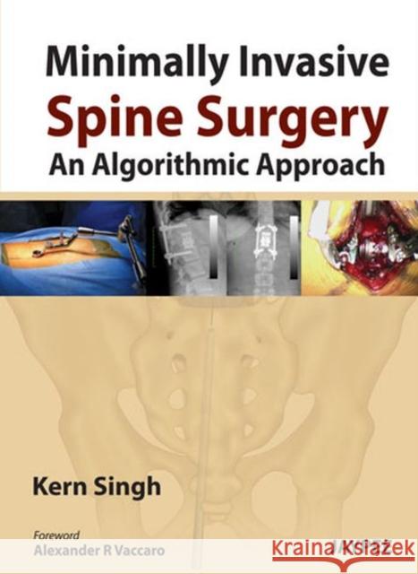 Minimally Invasive Spine Surgery: An Algorithmic Approach Kern Singh 9789350904848