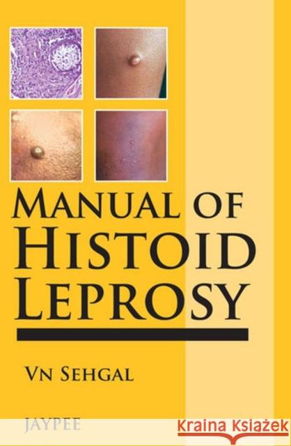 Manual of Histoid Leprosy Virendra N Sehgal, Govind Srivastava 9789350905159 Jaypee Brothers Medical Publishers