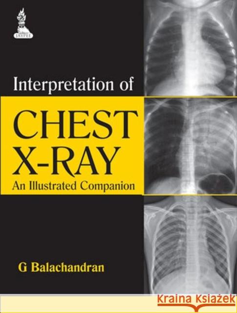 Interpretation of Chest X-Ray: An Illustrated Companion Balachandran, G. 9789351521723