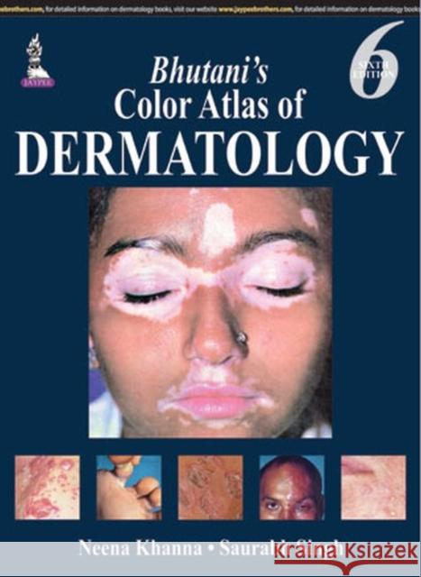 Bhutani's Color Atlas of Dermatology  Khanna, Neena 9789351523024