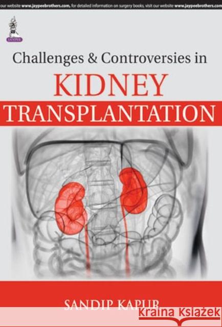 Challenges and Controversies in Kidney Transplantation  Kapur, Sandip 9789351525257
