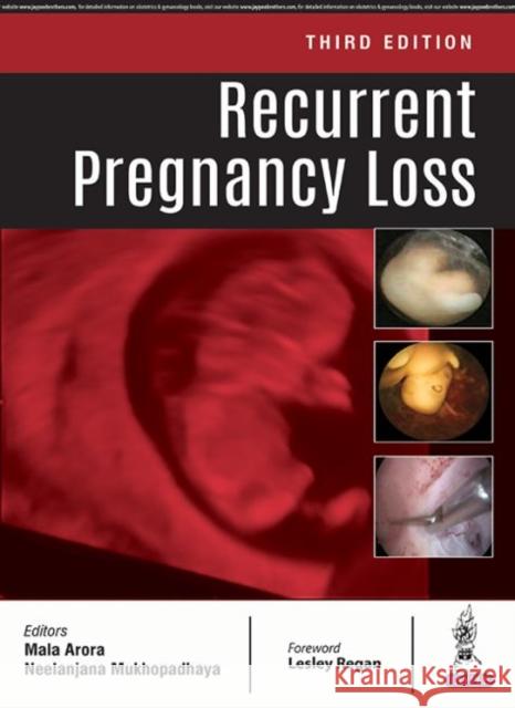 Recurrent Pregnancy Loss Mala Arora 9789352700912