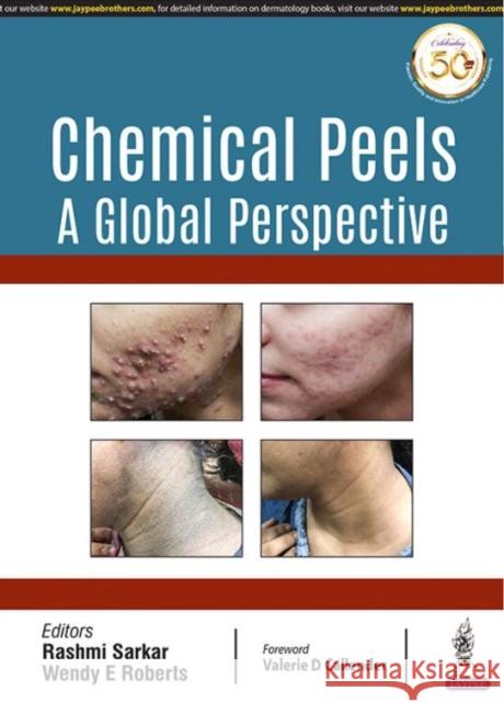 Chemical Peels: A Global Perspective Rashmi Sarkar 9789352703524