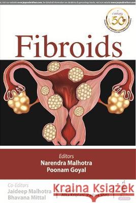 FIBROIDS Narendra Malhotra Poonam Goyal Jaideep Malhotra 9789352705498