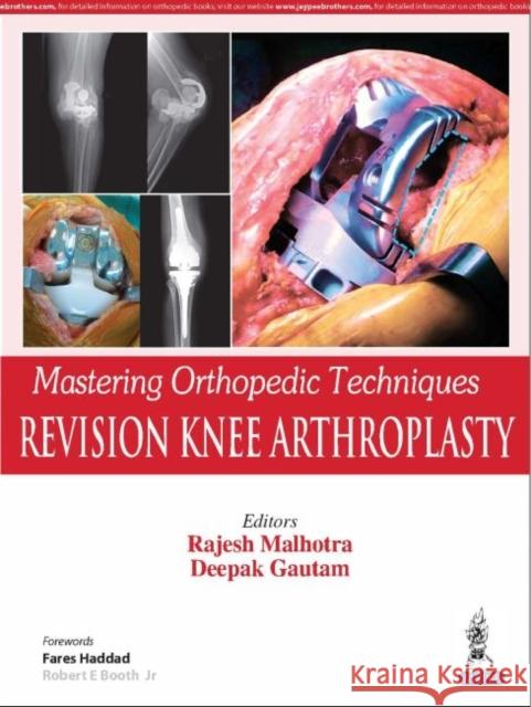 Mastering Orthopedic Techniques REVISION KNEE ARTHROPLASTY Rajesh Malhotra Deepak Gautam  9789352705832 