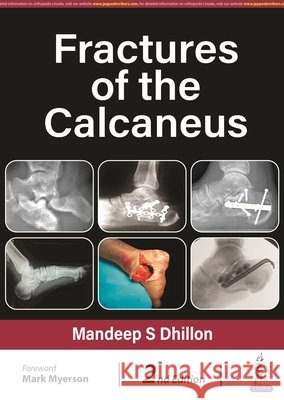 Fractures of the Calcaneus Mandeep S Dhillon 9789354656651