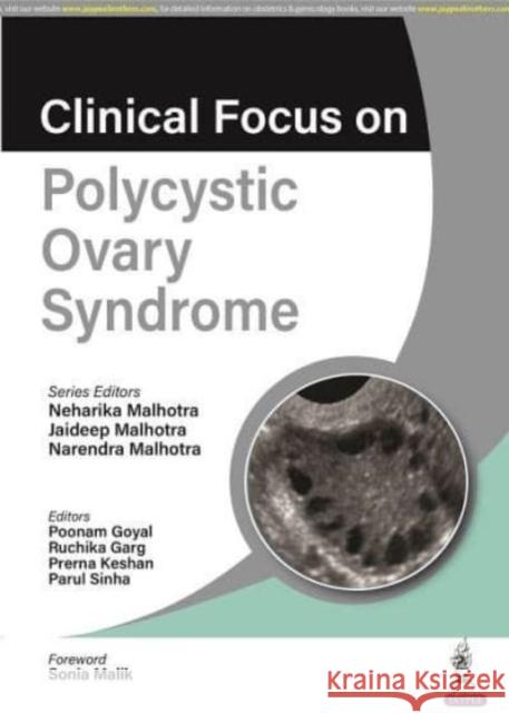 Clinical Focus on Polycystic Ovary Syndrome Neharika Malhotra Jaideep Malhotra Narendra Malhotra 9789356960916 Jaypee Brothers Medical Publishers