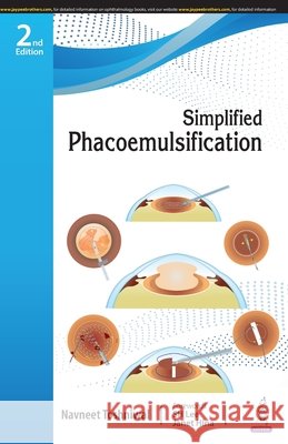 Simplified Phacoemulsification Navneet Toshniwal 9789356967380