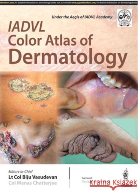 Iadvl Color Atlas of Dermatology Biju Vasudevan 9789385891212