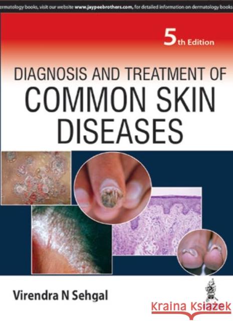 Diagnosis and Treatment of Common Skin Diseases Virendra N Sehgal 9789386056771 Jaypee Brothers Medical Publishers
