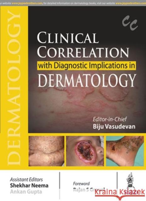 Clinical Correlation with Diagnostic Implications in Dermatology Biju Vasudevan 9789386322661