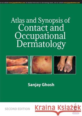 Atlas and Synopsis of Contact and Occupational Dermatology Sanjay Ghosh   9789388958615 Jaypee Brothers Medical Publishers
