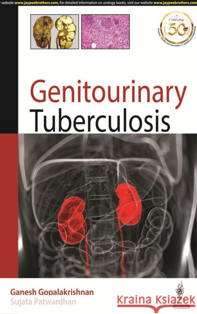 Genitourinary Tuberculosis Ganesh Gopalakrishnan Sujata Patwardhan  9789389776683 Jaypee Brothers Medical Publishers