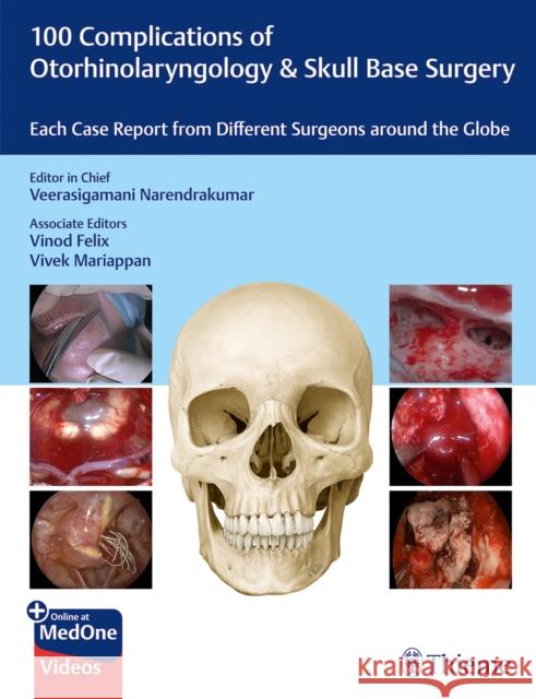 100 Complications of Otorhinolaryngology & Skull Base Surgery: Each Case Report from Different Surgeons around the Globe  9789395390576 Thieme Medical Publishers