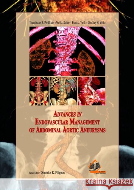 Advances in Endovascular Management of Abdominal Aortic Aneurysms Theodossios Perdikides 9789603997917 Broken Hill Medical