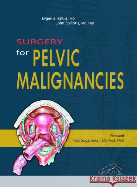 Surgery for Pelvic Malignances Evgenia Halkia 9789963716586 Broken Hill Medical