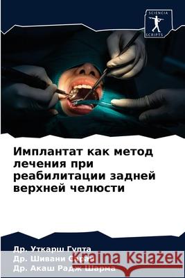 Имплантат как метод лече Гупта, 9786204032405 Sciencia Scripts - książka