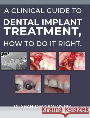 A guide to dental implant treatment, how to do it right. Shahram Namjoy 9781968615543 Dr Shahram Namjoy - książka