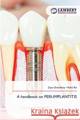 A handbook on PERI-IMPLANTITIS Zoya Chowdhary Rohit Rai 9786209115301 LAP Lambert Academic Publishing - książka