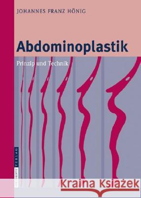 Abdominoplastik: Prinzip und Technik Johannes-Franz Hönig 9783798518162 Steinkopff Darmstadt - książka