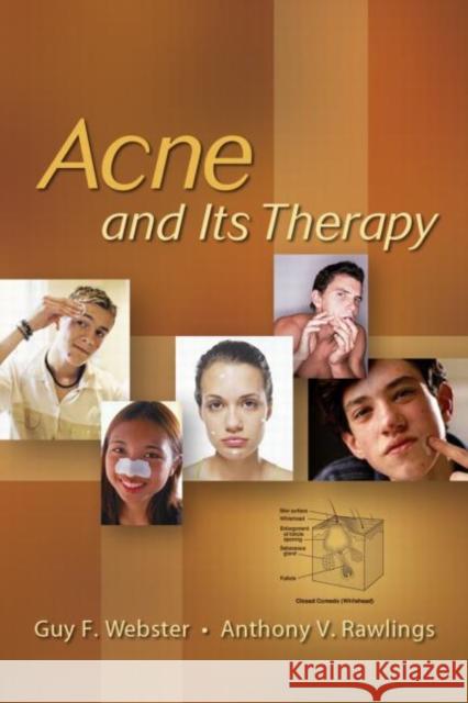 Acne and Its Therapy Guy F. Webster Anthony V. Rawlings 9780824729714 Informa Healthcare - książka