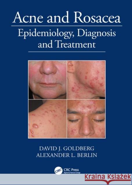 Acne and Rosacea: Epidemiology, Diagnosis and Treatment Goldberg, David 9781840761504  - książka