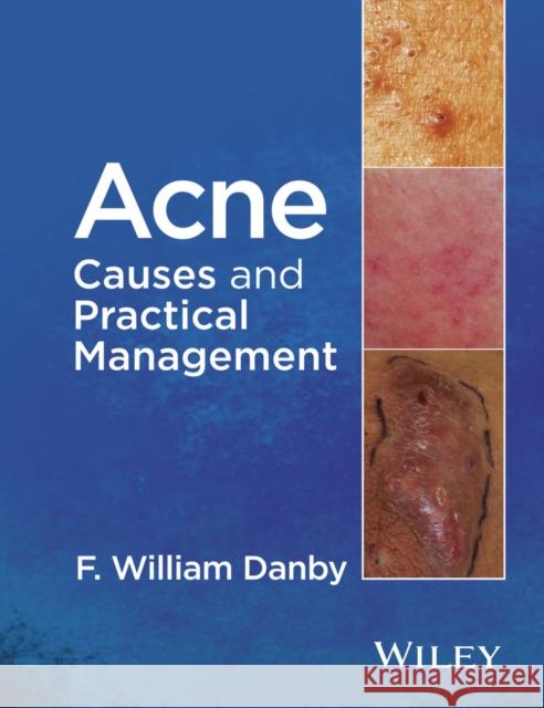 Acne: Causes and Practical Management Danby, F. William 9781118232774 John Wiley & Sons - książka