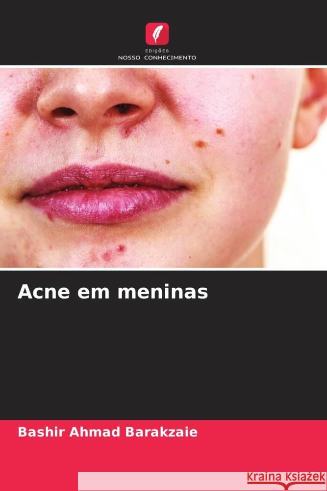 Acne em meninas Barakzaie, Bashir Ahmad 9786204831916 Edições Nosso Conhecimento - książka