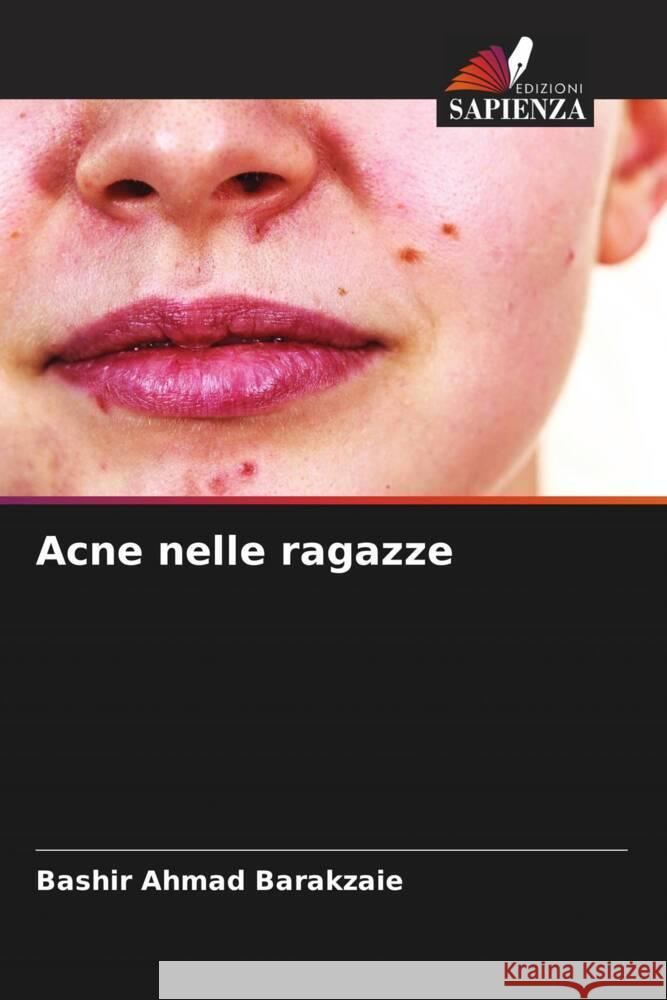 Acne nelle ragazze Barakzaie, Bashir Ahmad 9786204831862 Edizioni Sapienza - książka