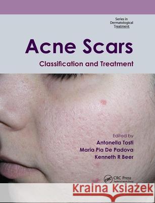 Acne Scars: Classification and Treatment Antonella Tosti Maria Pia D Kenneth R. Beer 9780367384715 CRC Press - książka