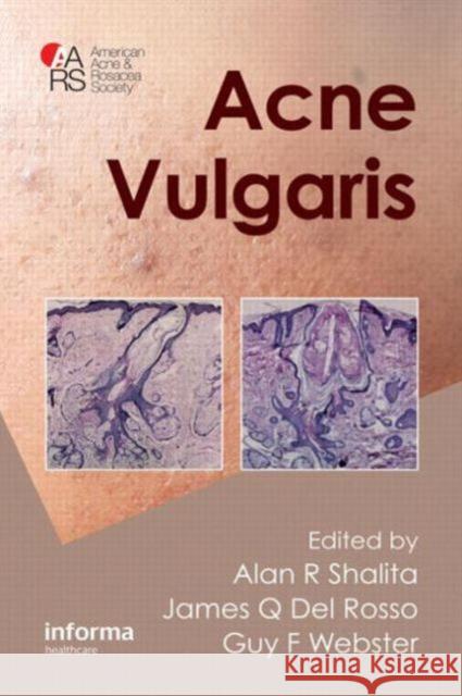 Acne Vulgaris Alan R. Shalita James Q. De Guy Webster 9781841847078 Informa Healthcare - książka