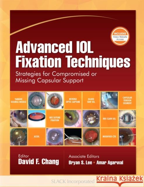 Advanced Iol Fixation Techniques: Strategies for Compromised or Missing Capsular Support David F. Chang 9781630915810 Slack - książka