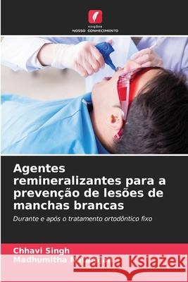 Agentes remineralizantes para a preven??o de les?es de manchas brancas Chhavi Singh Madhumitha Natarajan 9786207388974 Edicoes Nosso Conhecimento - książka