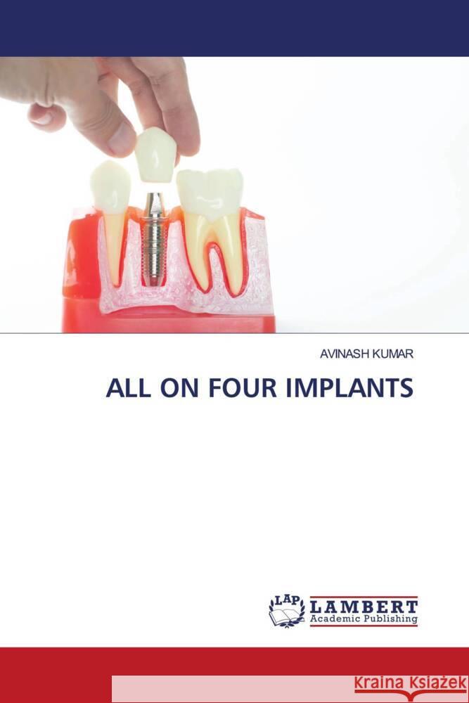 ALL ON FOUR IMPLANTS Kumar, Avinash 9786208225308 LAP Lambert Academic Publishing - książka