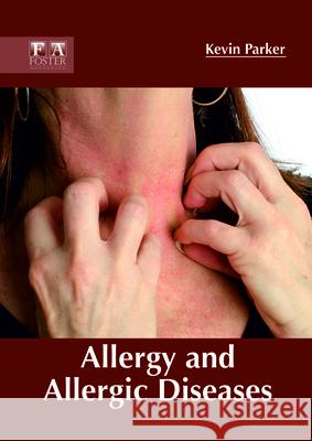 Allergy and Allergic Diseases Kevin Parker 9781632425256 Foster Academics - książka