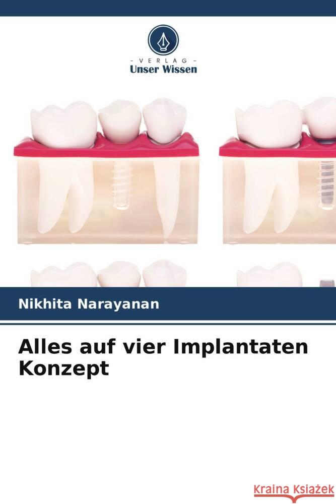 Alles auf vier Implantaten Konzept Narayanan, Nikhita 9786204824796 Verlag Unser Wissen - książka